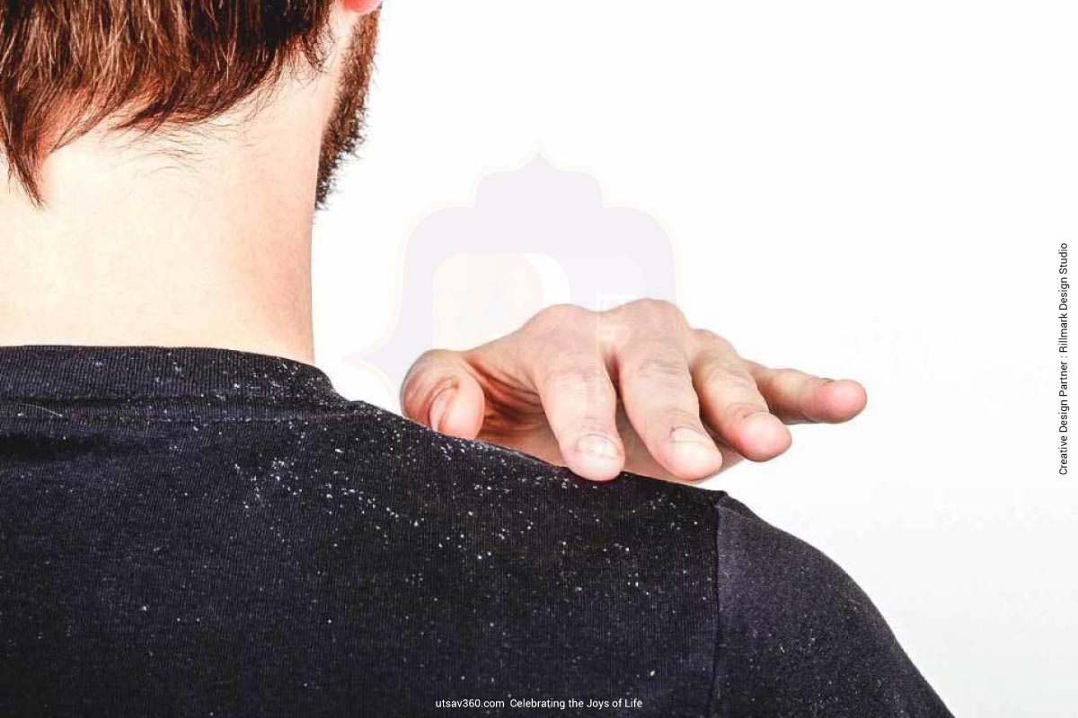 why-does-dandruff-double-in-your-hair-during-winter-utsav-360